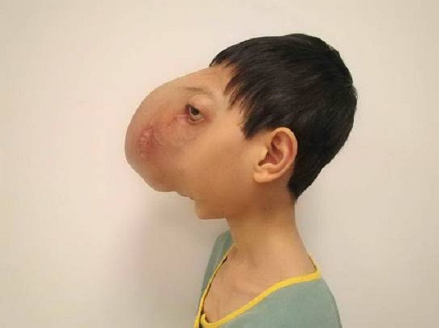 Em Lê Trung Tuấn từng bị khối u che hết khuôn mặt và bị ảnh hưởng tới khả năng nghe, nhìn