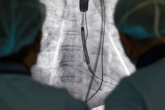 Ống thông được luồn qua da từ động mạch đùi đến động mạch chủ để thay van tim cho bệnh nhân