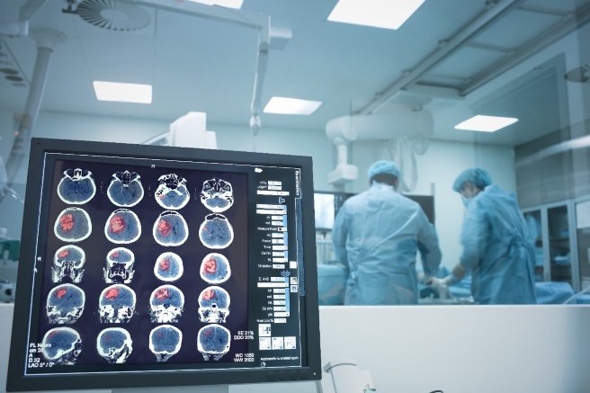 Bệnh viện Nhân Dân 115 đã trở thành đơn vị đầu tiên ở khu vực Châu Á thực hiện thành công kỹ thuật mổ u não bằng robot Modus V Synaptive (hình minh họa)