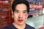 Diễn viên Thiên Nguyễn bất ngờ bị đánh chảy máu mũi, mẻ răng ở Sydney