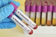 Chỉ số hồng cầu nhỏ báo hiệu bệnh Thalassemia - Cảnh báo di truyền nguy hiểm