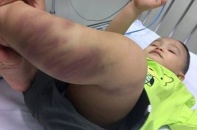 Bé hơn 1 tuổi nhập viện nguy kịch, nghi bị bạo hành