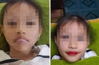 Thẩm mỹ viện phun môi cho bé gái 5 tuổi