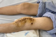 Bệnh nhân lao khớp gối đầu tiên được thay khớp gối nhân tạo