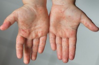 Hai biến chứng nặng nhất của tay chân miệng cần đặc biệt lưu ý