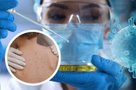 Tin mới về y tế ngày 28/5: Đậu mùa khỉ lan nhanh, WHO yêu cầu tăng giám sát