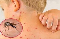 Ứng phó với sốt xuất huyết tại các "điểm nóng"