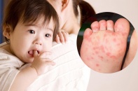 Tin mới về y tế ngày 29/9: Bệnh tay chân miệng có xu hướng gia tăng; Phát hiện một trường hợp nhiễm sốt rét hiếm gặp