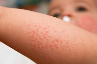 TP.HCM ứng phó khẩn cấp với dịch sốt xuất huyết