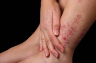 Bệnh lý về da tăng cao do thời tiết hanh khô