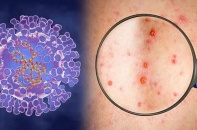 Tin mới về y tế ngày 9/11: Kiểm tra công tác phòng, chống bệnh đậu mùa khỉ tại Đồng Nai; Ghi nhận thêm một trường hợp mắc bệnh Whitmore