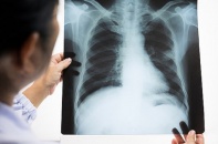 Nhiều kỹ thuật mới trong điều trị ung thư phổi