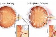Tin mới về y tế ngày 14/3: Tầm soát và phát hiện sớm bệnh Glôcôm; Hà Nội tăng số ca mắc sốt xuất huyết và tay chân miệng 