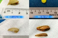 Tin mới về y tế ngày 17/3: Cảnh báo tai nạn nguy hiểm do hóc dị vật đường thở ở trẻ