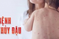 Bệnh thủy đậu tăng cao bất thường, người dân cần làm gì để phòng chống?