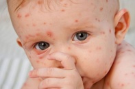 Cảnh giác biến chứng của bệnh thủy đậu