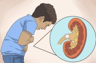 Cảnh báo bệnh lý sỏi thận ở trẻ em