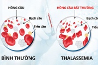 Gánh nặng bệnh tan máu bẩm sinh 