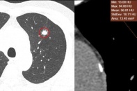 Bàng hoàng vì phát hiện ung thư phổi giai đoạn cuối sau 20 năm hút thuốc lá