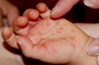 Tin mới về y tế ngày 4/6: Giám sát, xử lý triệt để ổ dịch tay chân miệng; Phẫu thuật thành công ung thư phổi bằng hệ thống robot
