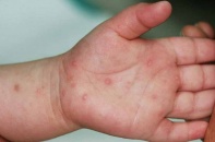 Tin mới về y tế ngày 7/6: Bộ Y tế yêu cầu khẩn trương phòng dịch tay chân miệng
