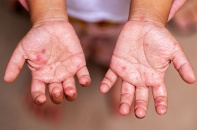 Tin mới về y tế ngày 9/6: Cẩn trọng với bệnh tay chân miệng