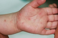 Bộ Y tế yêu cầu tăng cường các biện pháp phòng chống tay chân miệng