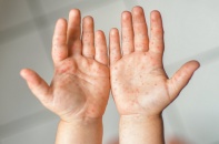 Tin mới về y tế ngày 15/6: Chỉ đạo khẩn về phòng, chống và điều trị bệnh tay chân miệng