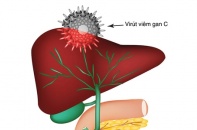 Tin mới về y tế ngày 29/7: Hơn 8 triệu người Việt mắc viêm gan