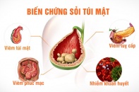 Liên tiếp bệnh nhân nhập viện do biến chứng sỏi mật