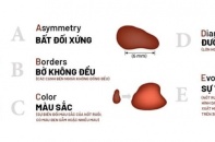 Tăng nhanh lượng bệnh nhân mắc ung thư tế bào hắc tố