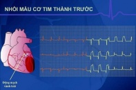 Ứng dụng công nghệ mới trong điều trị nhồi máu cơ tim