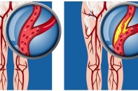 Biến chứng của bệnh lý động mạch