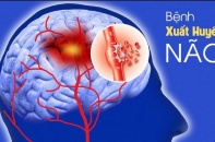 Cảnh báo gia tăng ca mắc xuất huyết não ở người trẻ 