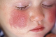 Cảnh báo tình trạng dị ứng đạm sữa bò ở trẻ