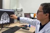 Kỳ tích phẫu thuật giảm 90% cơn động kinh sau 21 năm khổ sở