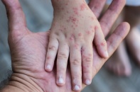 Mối lo lây nhiễm chéo sởi trong bệnh viện