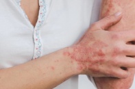 Đầu hè, bệnh nhân da liễu tăng mạnh