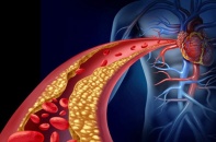 Rối loạn mỡ máu đang trẻ hóa