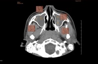 Bệnh lý tai mũi họng ở trẻ có thể gây ra biến chứng nguy hiểm