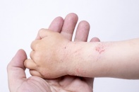 Tin mới y tế ngày 18/8: Gia tăng các bệnh lý về da ở trẻ trong kỳ nghỉ hè