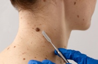 Cảnh báo vết loét nhỏ có thể là dấu hiệu ung thư da