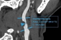 Hút thuốc lá 30 năm, phát hiện bệnh lý tim mạch nguy hiểm