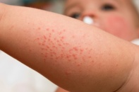 Tự điều trị sốt xuất huyết tại nhà, bệnh nhân đối mặt biến chứng nặng