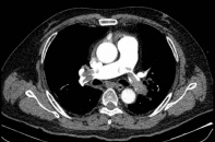 Mỗi điếu thuốc là một bước gần hơn tới phòng cấp cứu