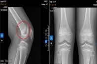 Cảnh báo bệnh lý dễ bị bỏ qua khiến nhiều trẻ đau gối kéo dài khi vận động mạnh