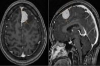 U màng não, bệnh lý tiến triển âm thầm nhưng nguy hiểm