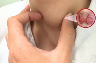 Bé trai 13 tuổi mắc ung thư tuyến giáp thể hiếm gặp