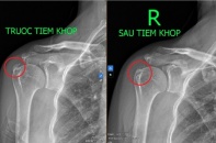 Đau vai âm ỉ kéo dài, dấu hiệu bệnh viêm gân vôi hóa