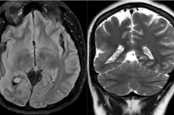 Triệu chứng quen thuộc hé lộ hội chứng mạch máu hiếm gặp